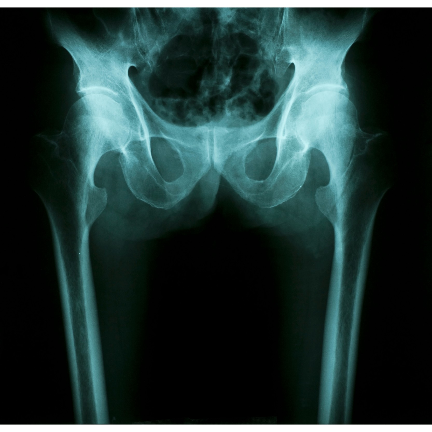 Hip replacement in India Einstagore