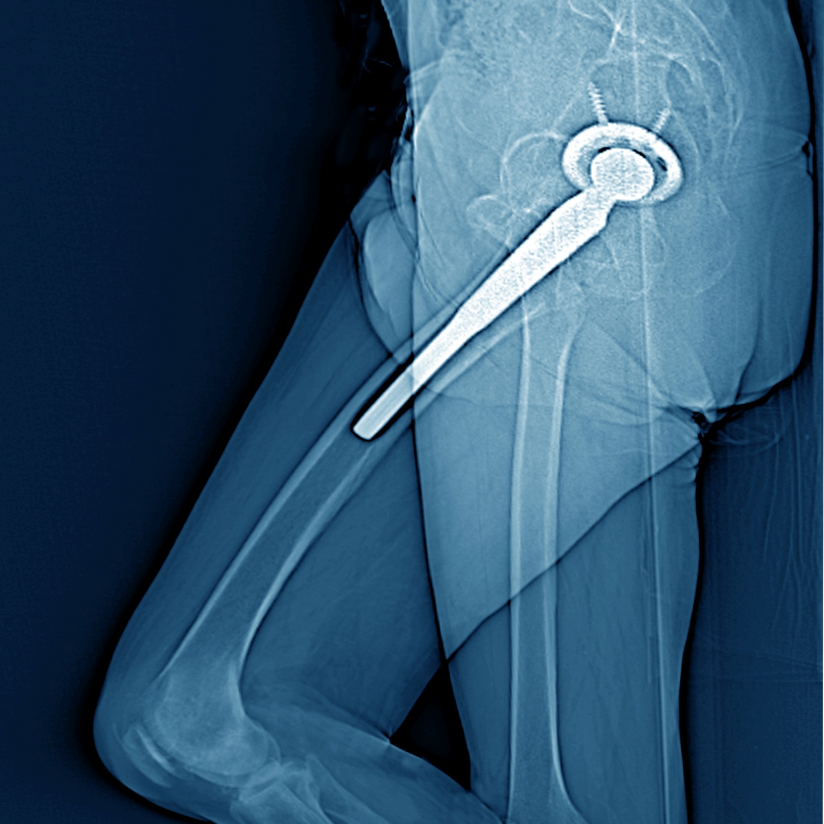 Hip replacement in India Einstagore