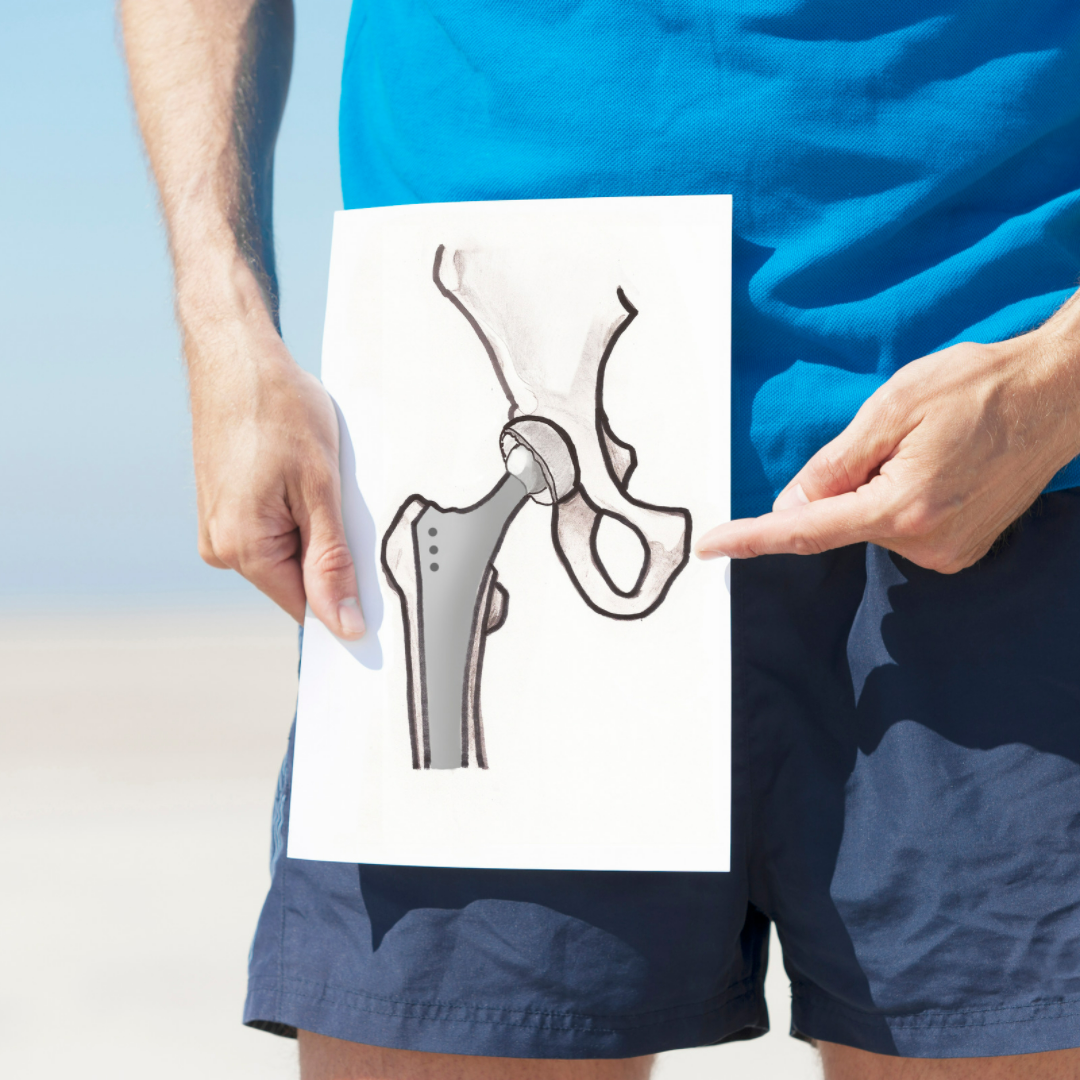 Best hip replacement surgery in India